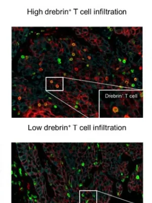 Characterization of the Spatial Immune Context of Lung Cancer