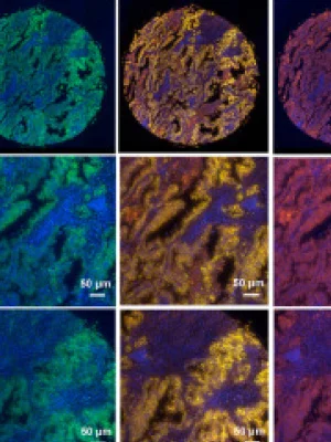 CpG Methylation Influence on Protease Serine 3 Isoforms in Lung Cancer