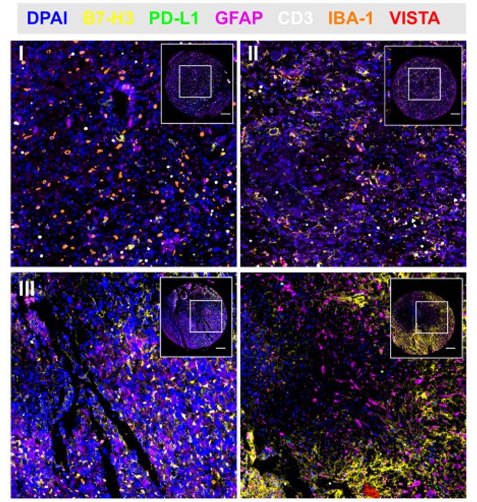 Glioma