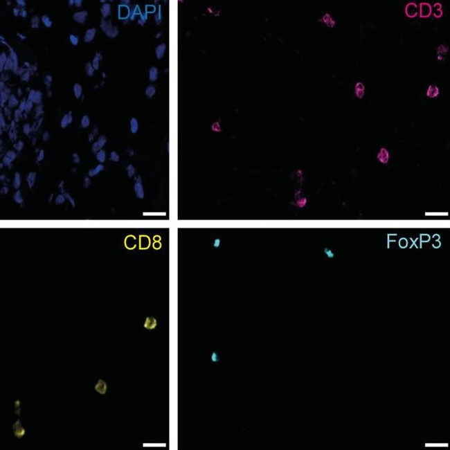 Anti-Neoplastic Effects of Calcium